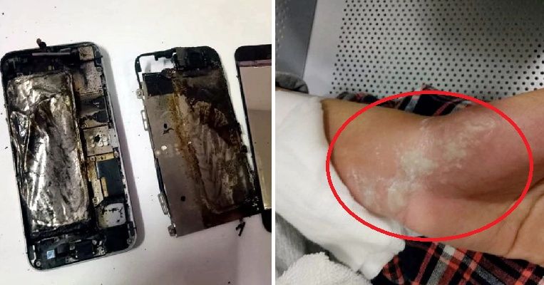 Tangan wanita terbakar setelah menyentuh ponselnya yang di-charge semalaman.