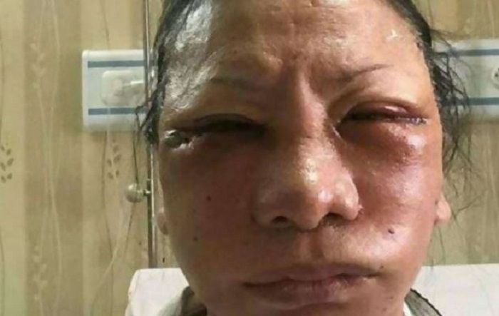 Ratna Sarumpaet bengkak pascaoperasi sedot lemak pada wajah.