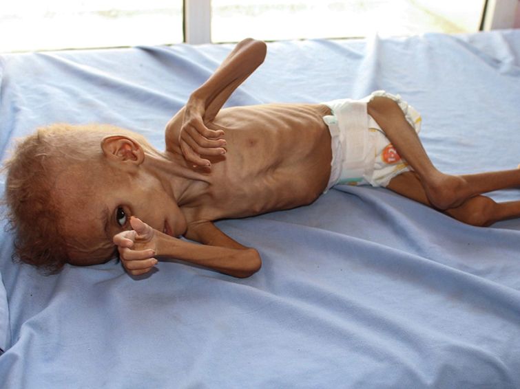 Seorang anak di Yaman mengalami kelaparan dan terbaring lemah di salah satu rumah sakit di Yaman