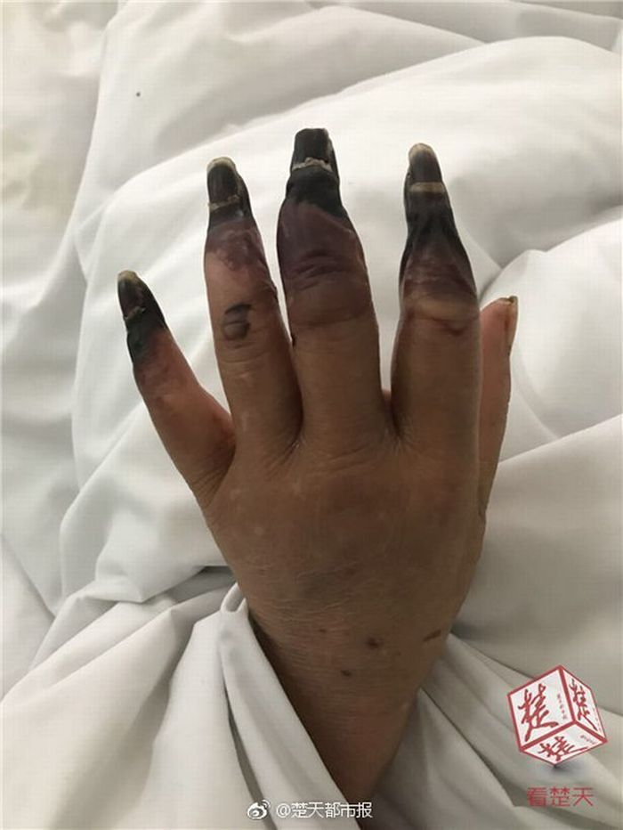 jari-jari yang terinfeksi
