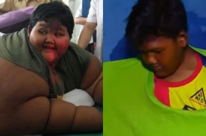 Transformasi Arya Permana Si Bocah Obesitas dengan Berat 192 Kg, Kini Penampilannya Bikin Pangling!