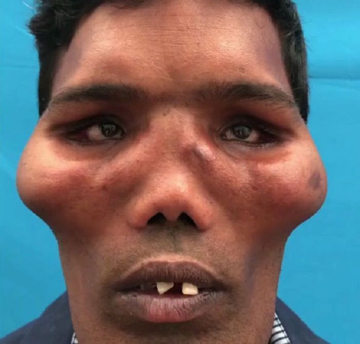 Punya Penyakit Langka Hingga Memiliki 'Wajah Singa', Intip Transformasi Pria ini Setelah Operasi