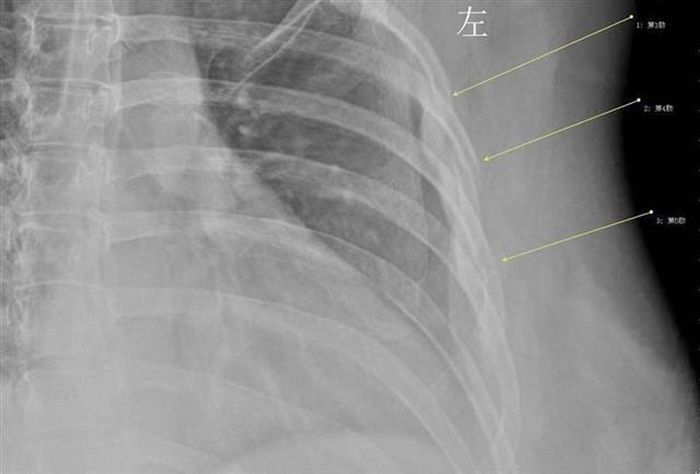 Hasil scan sinar X yang menunjukkan tulang kropos.