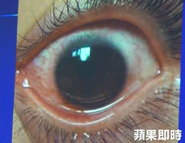 Matanya sakit setelah dua tahun menggunakan smartphone dengan kecerahan maksimum.