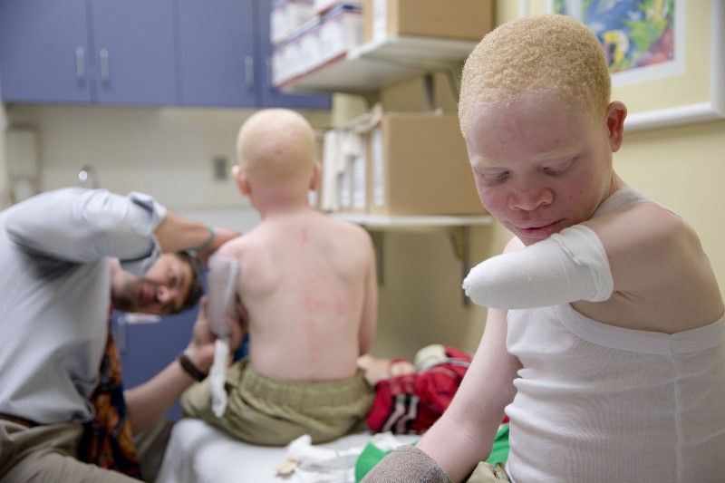 Tragis! Anak Albino di Afrika Jadi Buruan Untuk Diambil Bagian Tubuhnya yang Dianggap 'Bertuah'
