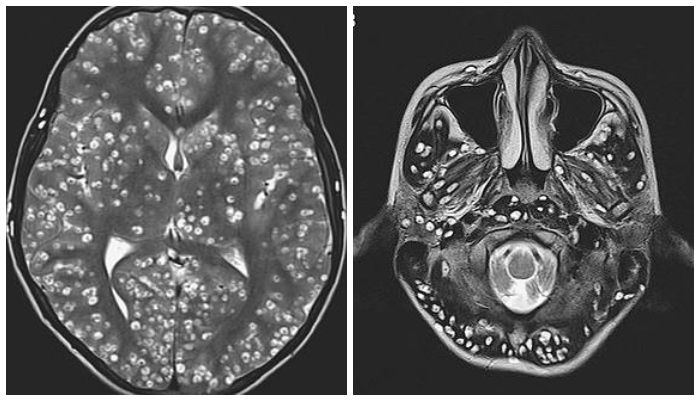 Hasil pindai MRI otak pasien dengan ratusan cacing pita bersarang di otaknya.