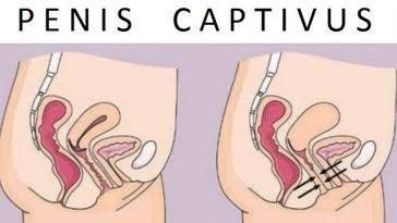 penis captivus