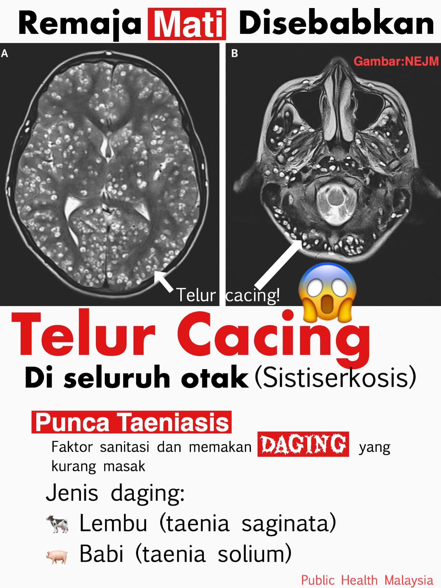 Telur cacing di seluruh otak.