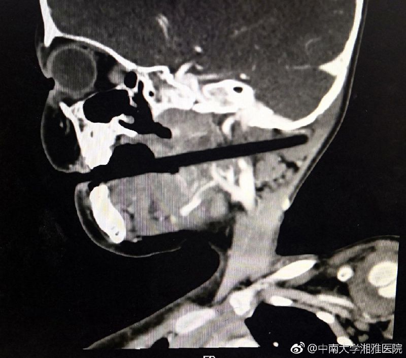 Hasil CT scan yang menunjukkan sumpit itu menembus tengkoraknya