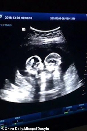 Tangkapan layar hasil USG ketika janin kembar ini bertengkar di rahim ibunya