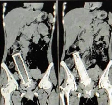 Hasil CT scan korban