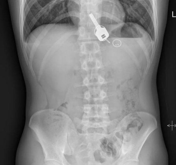 Hasil X-Ray menunjukkan bahwa kunci bersarang di tubuh Chang.