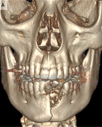 Rahang seorang remaja rusak setelah vape meledak dimulutnya