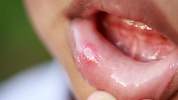 Waspadai Bercak Putih atau Kemerahan di Bibir, Bisa Jadi Tanda Kanker Mulut!