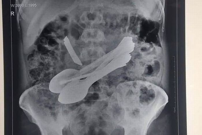 Hasil sinar X yang memperlihatkan perut seorang pria di India. Di dalamnya, dokter menemukan benda seperti obeng hingga sendok.