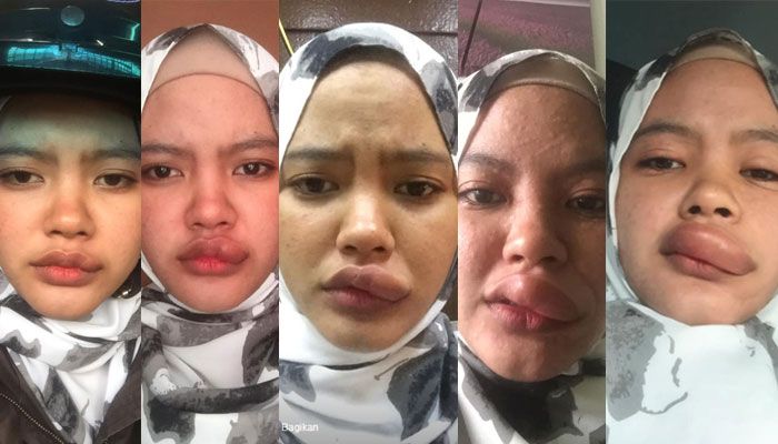 Bibir Digigit Serangga Saat Naik Motor Atasi Dengan Bumbu Dapur Semua Halaman Otofemale