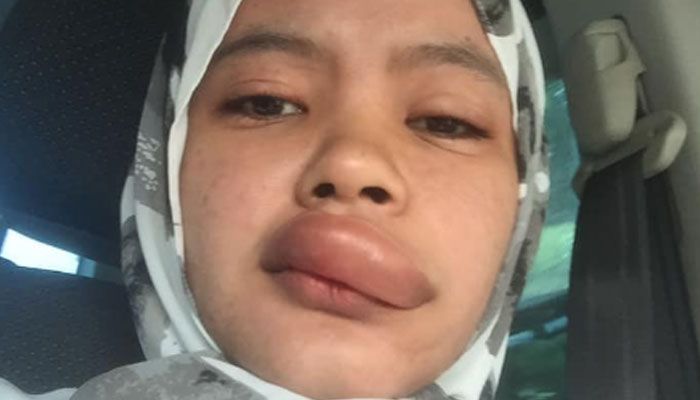 Bibir Kak Ida mendonat setelah digigit serangga.