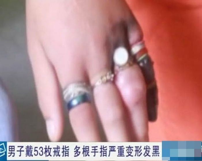 Inilah cincin-cincin yang menempel di tangan pria tersebut sebelum dilepaskan.