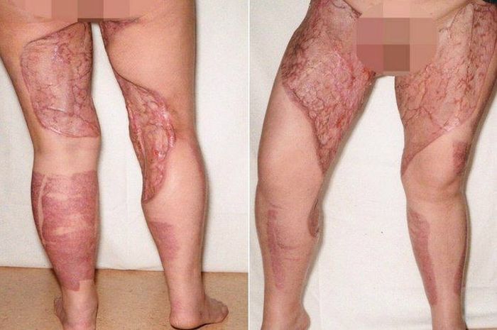 Yang terjadi pada kaki wanita ini gegara mencukur bulu kemaluannya.
