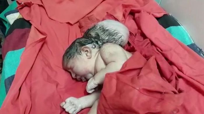 Bayi perempuan malang itu lahir dengan 'tiga kepala' setelah ibunya mengeluhkan rasa sakit sebelum melahirkan