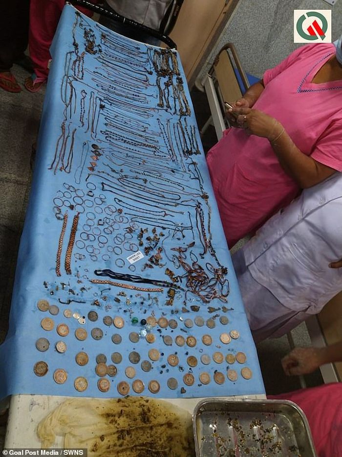 Dokter mengeluarkan 69 rantai, 80 anting, 46 koin, 8 locket, 11 cincin hidung, 4 kunci, 5 gelang kaki, dan 1 jam tangan dari perutnya.