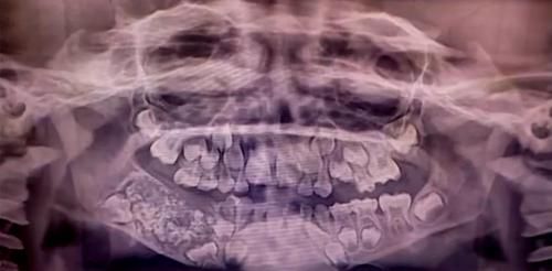 Sering Sakit Gigi dan Bengkak, Ternyata Bocah Ini Punya Ratusan Gigi di Mulutnya, Lihat Videonya!