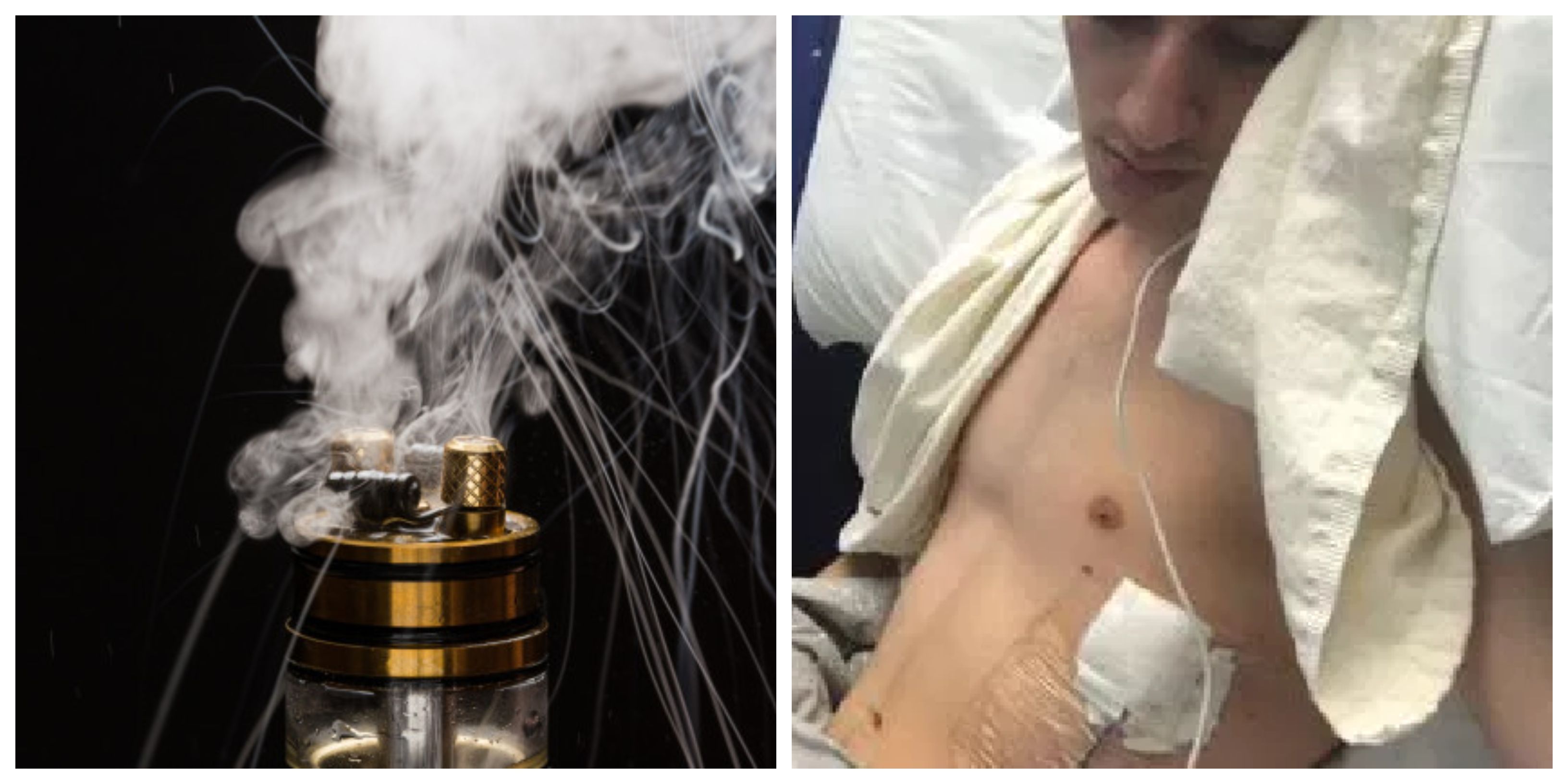 Pakai vape setahun, paru-paru mahasiswa rusak dan harus jalani operasi mendadak