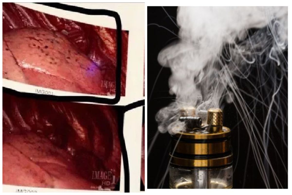 Begini penampakan paru-paru pengguna vape