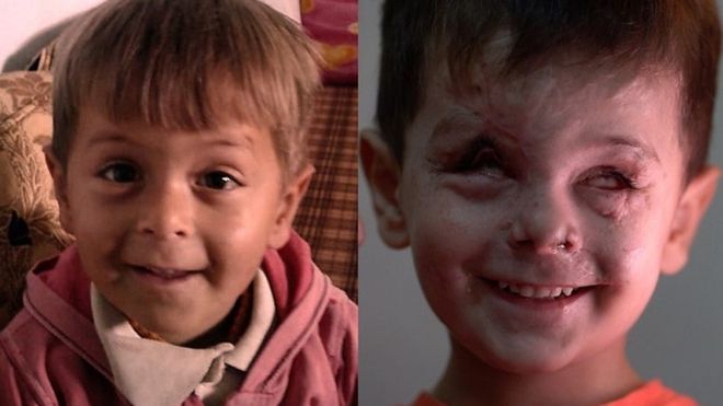 perbandingan wajah Jouma ketika sebelum dan sesudah terkena serangan udara perang saudara di Suriah