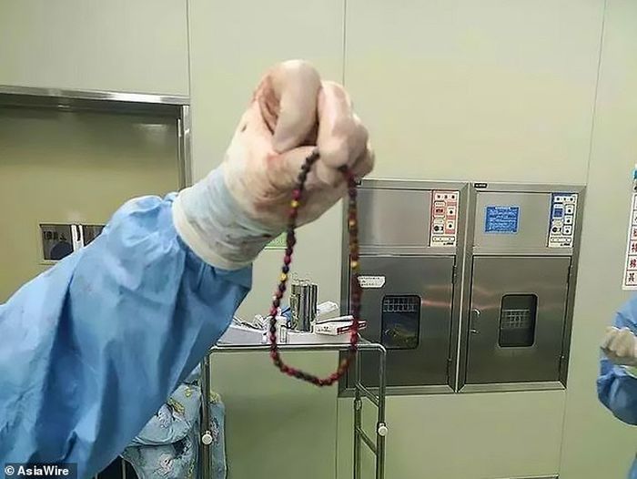 Dokter keluarkan manik-manik dari perut pasien