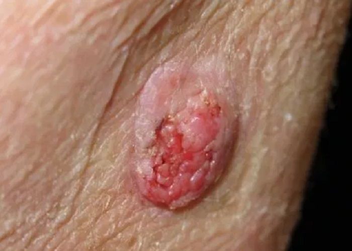 Karsinoma sel skuamosa adalah jenis lain dari kanker kulit 
