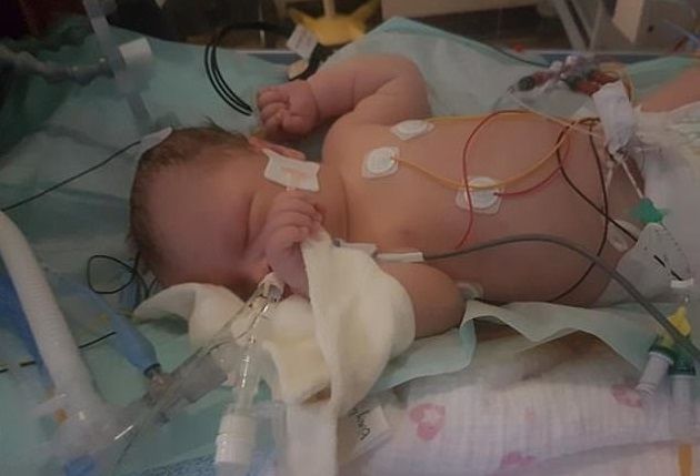 Eva, Bayi yang tak bernapas selama 28 menit setelah lehernya terlilit tali pusar