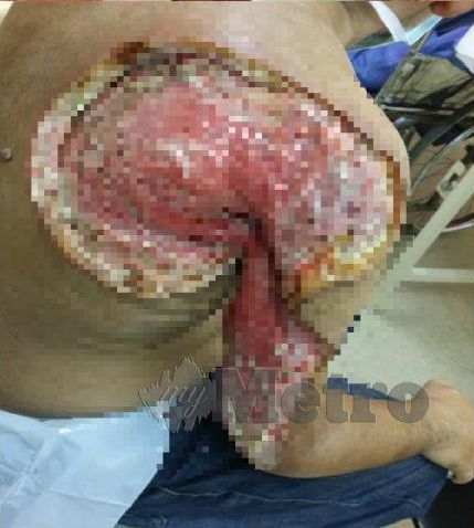 Infeksi yang terjadi di tangan Mohd Razin