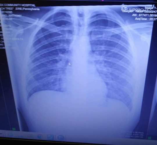 Hasil x-ray paru-paru Anthony