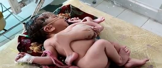 Bayi yang lahir dengan keadaan tak biasa