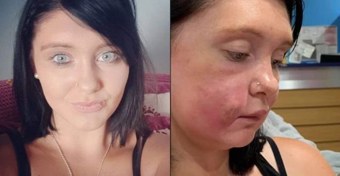 Lakukan Filler Pada Wajah Sendiri Penampilan Wanita 26 Tahun Ini Bukannya Jadi Cantik Tapi Malah Mengerikan Lakukan Filler Pada Wajah Sendiri Penampilan Wanita 26 Tahun Ini Bukannya Jadi Cantik Tapi Malah Mengerikan