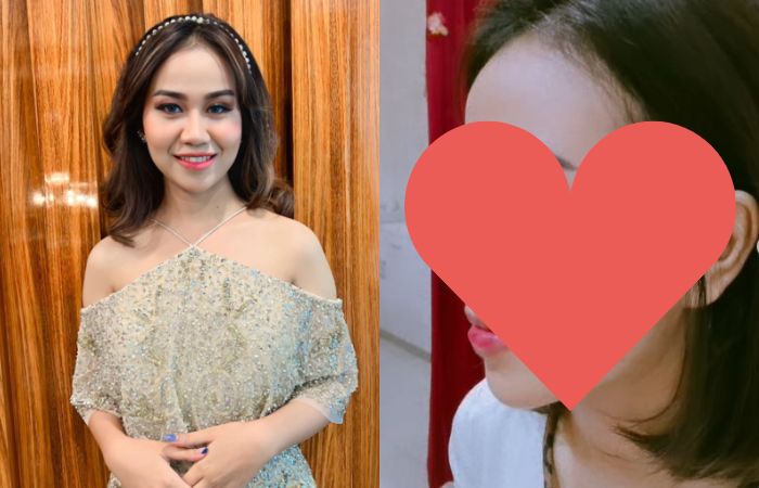 Mayang Adik Vanessa Angel Lepas Perban Begini Bentuk Hidung Barunya