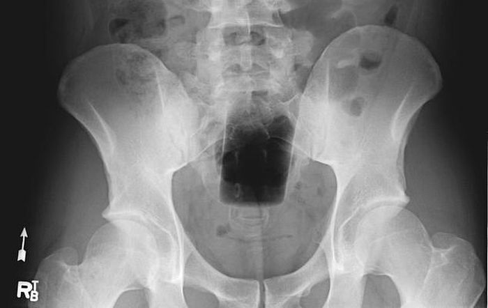 Image result for Hip arthroscopy