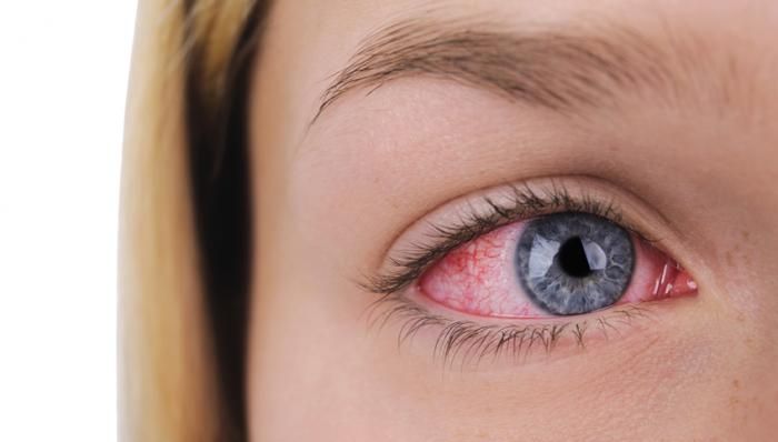 Benarkah sakit mata dapat menular hanya karena melihat mata penderita?