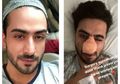 Aktor Bollywood Aly Goni Kesakitan Paska Lakukan Operasi Hidung