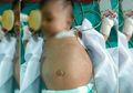 Perutnya Terus Membesar, Siapa Sangka Dalam Perut Bayi Ini Terdapat Bayi Lain