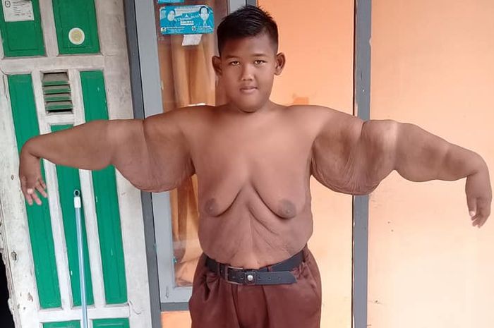 Arya Permana, bocah obesitas yang viral kini berbobot 90 kg