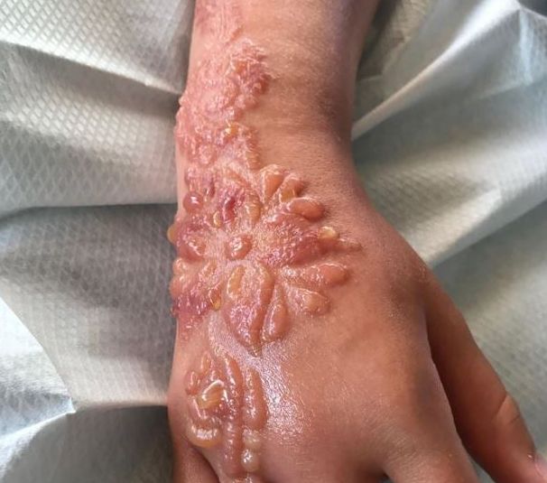 Tangan Madison Gulliver jadi melepuh detelah ditato dengan black henna