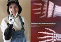 Tangan Perempuan ini Harus Rela Diganti, Penyebabnya Memilukan!