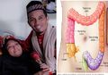 Istri Ustaz Maulana Meninggal Karena Kanker Usus: Ini Gejala dan Faktor Risiko yang Sering Diabaikan