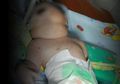 Bayi Bermata Satu Tanpa Hidung Lahir di Mandailing Natal, Kemungkinan Ini Penyebabnya!