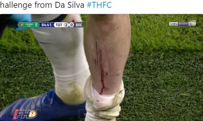 Kondisi kaki gelandang Tottenham Hotspur, Pierre-Emile Hojbjerg, yang berdarah usai ditekel oleh gelandang Brentford, Josh Dasilva, dalam laga semifinal Piala Liga Inggris, Selasa (5/1/2020).