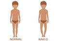 Normalkah Anak Miliki Kaki O dan Bisakah Sembuh? Ini Penjelasannya