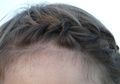 Wah, Ternyata Ketombe Berkaitan dengan Rambut yang Rontok, lo!