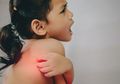 Eksim Bisa Menyerang Anak-Anak Seperti Kita, Apa Itu Eksim, ya?